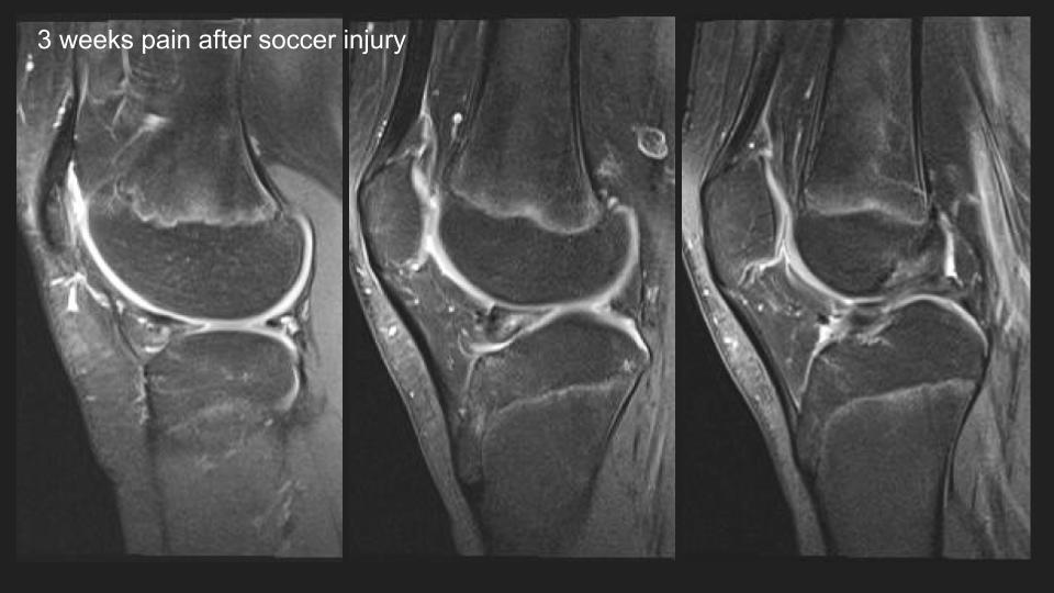 Figure 1 for case discoid lateral meniscus ( RID2771 )